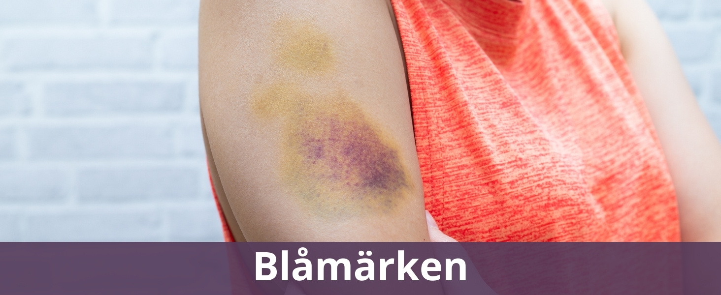 Blåmärken