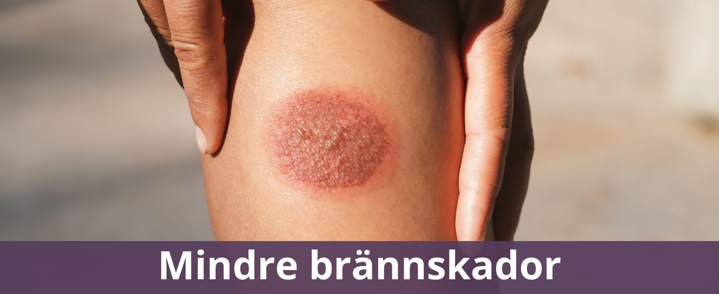 Mindre brännskador