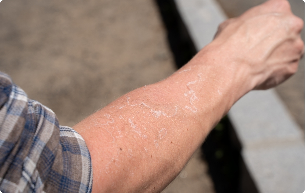 Som olja för irriterad och torr hud